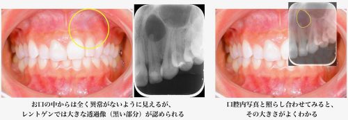 歯根 嚢胞 治療