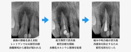 歯根や歯ぐきに膿がたまる病気 枚方の歯医者 本多歯科