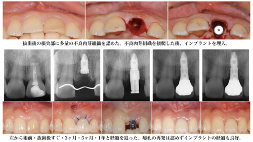 歯根や歯ぐきに膿がたまる病気 枚方の歯医者 本多歯科